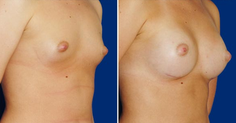 Breast Implants