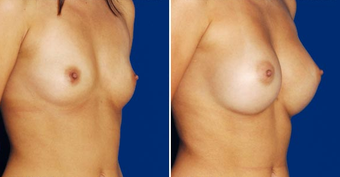 Breast Implants