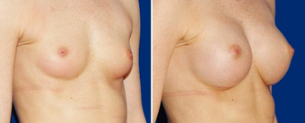 Breast Implants