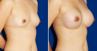 Breast Implants