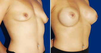 Breast Implants