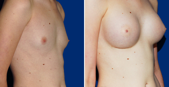 Breast Implants