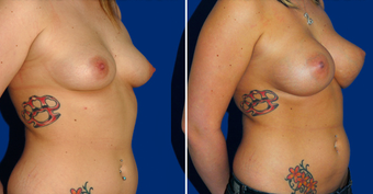 Breast Implants