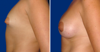 Breast Implants