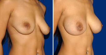 Breast Implants