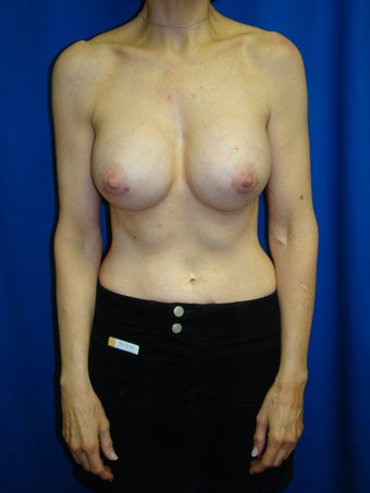 Breast Augmentation Revision