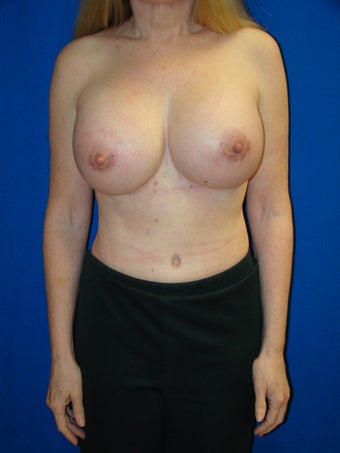 Breast Augmentation Revision