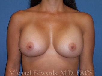 Breast Augmentation 
