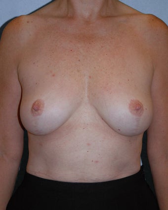 Breast Augmentation Style 410