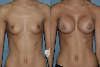 Breast Augmentation - Silicone Implants
