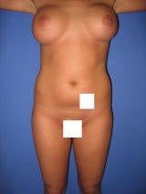 Liposuction Surgery