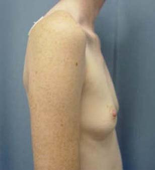 Breast Augmentation 