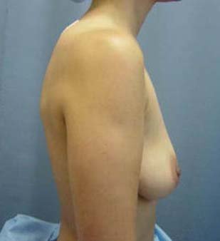 Breast Augmentation 