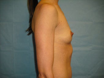 Breast Implants