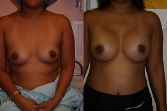 Breast augmentation