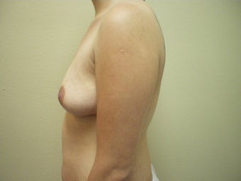 Breast Augmentation