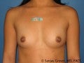 Breast Augmentation