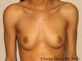 Breast Augmentation