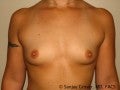 Breast Augmentation