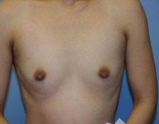 Breast implants