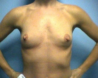 Breast implants