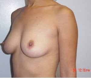 Breast implants