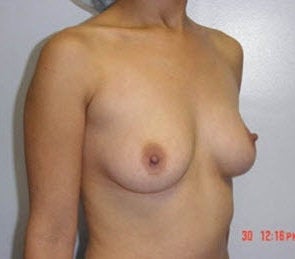 Breast implants