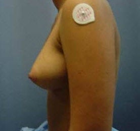 Breast implants
