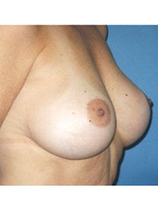 Corrective Breast Implant Surgery