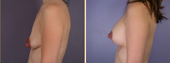 Breast Implants