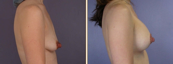 Breast Implants