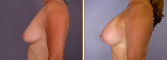 Breast Implants