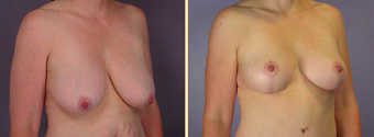 Breast Implants