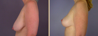 Breast Implants