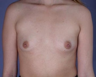Breast Augmentation