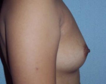 Breast Augmentation
