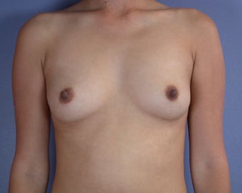 Breast Augmentation