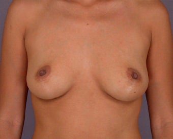 Breast Augmentation
