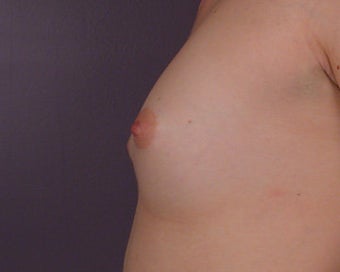 Breast Augmentation
