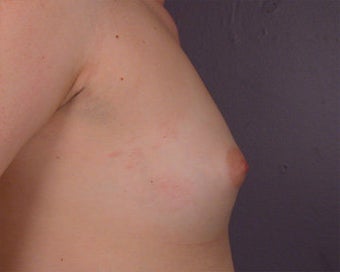 Breast Augmentation