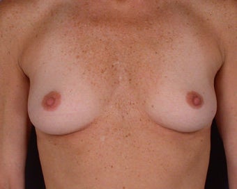 Breast Augmentation