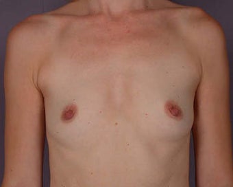Breast Augmentation