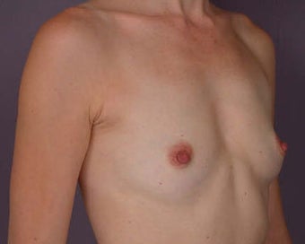 Breast Augmentation