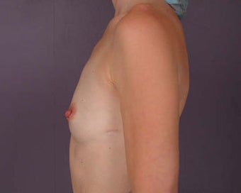 Breast Augmentation