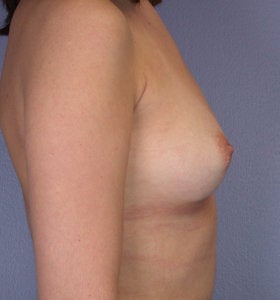 Breast Augmentation