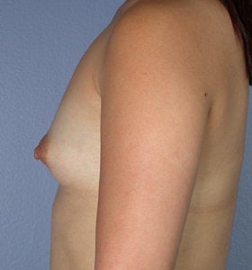 Breast Augmentation