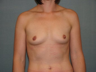 Breast Augmentation