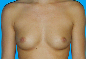 Breast Augmentation