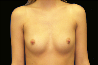 Breast Augmentation