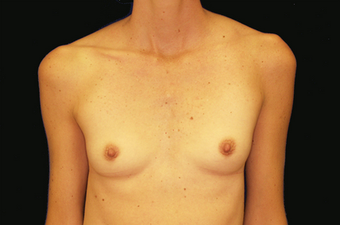Breast Implants